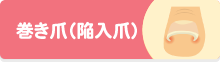 巻き爪（陥入爪）